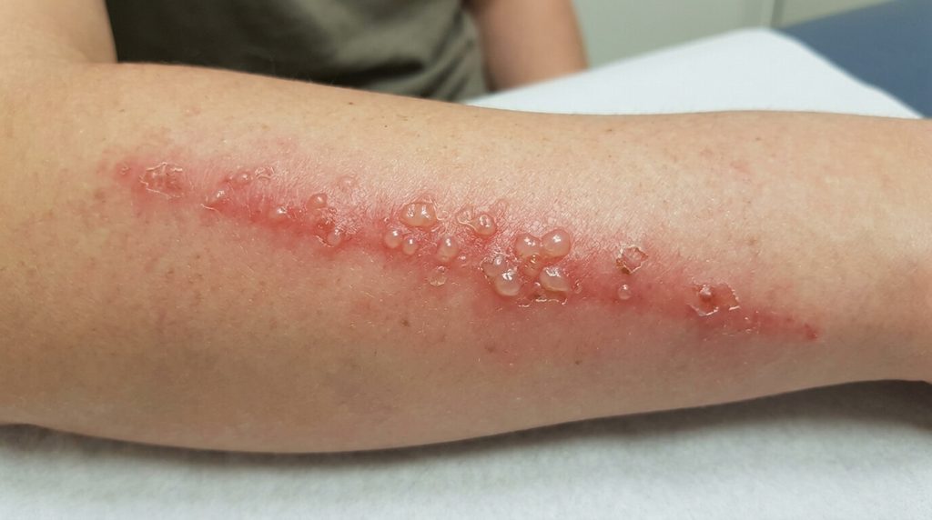 Tomcat insecte : piqûre de la mouche charognarde, brûlure et soins 4 Lésion cutanée linéaire rouge avec cloques causée par la toxine de l'insecte Tomcat.
